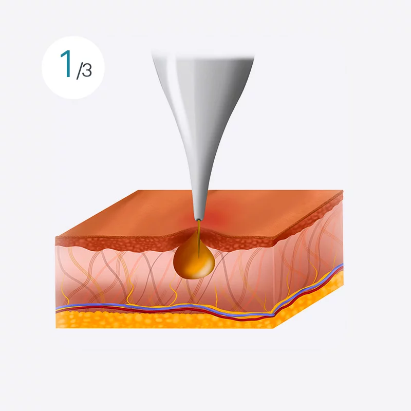 Monopolar RF treatment image 1