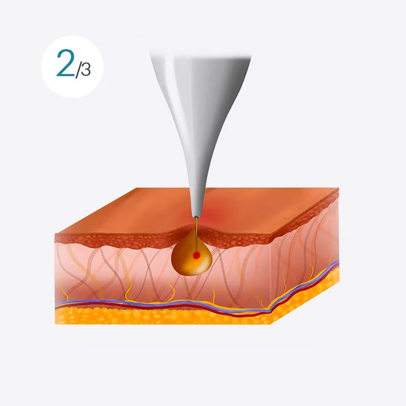 Monopolar RF treatment image 2