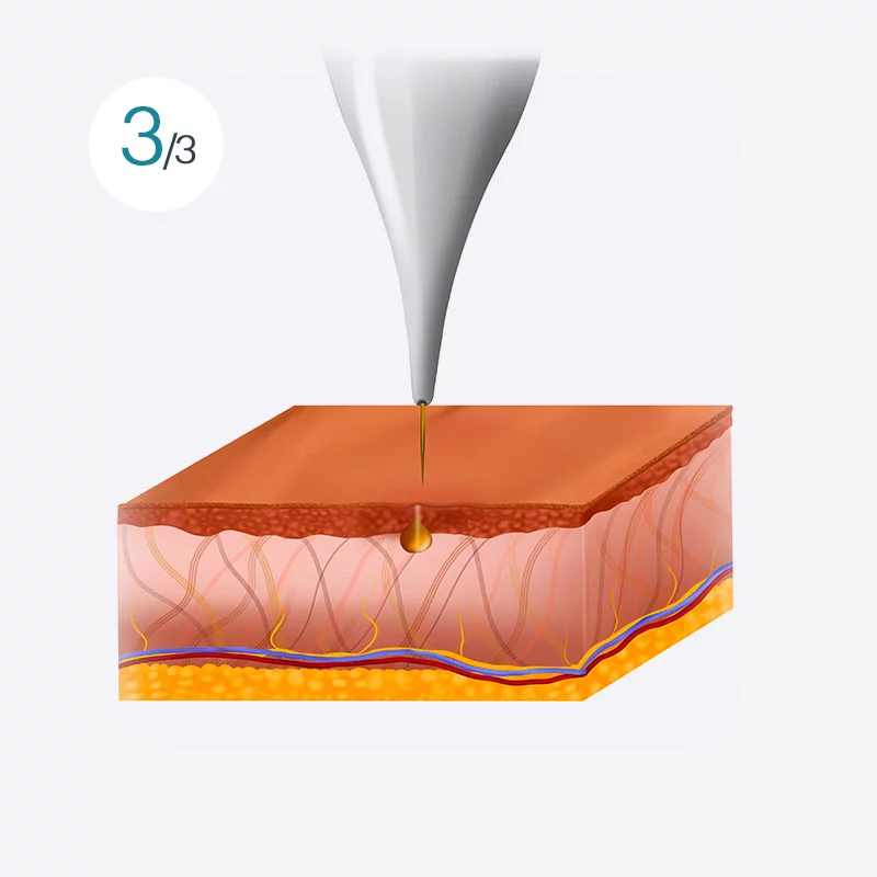 Monopolar RF treatment image 3